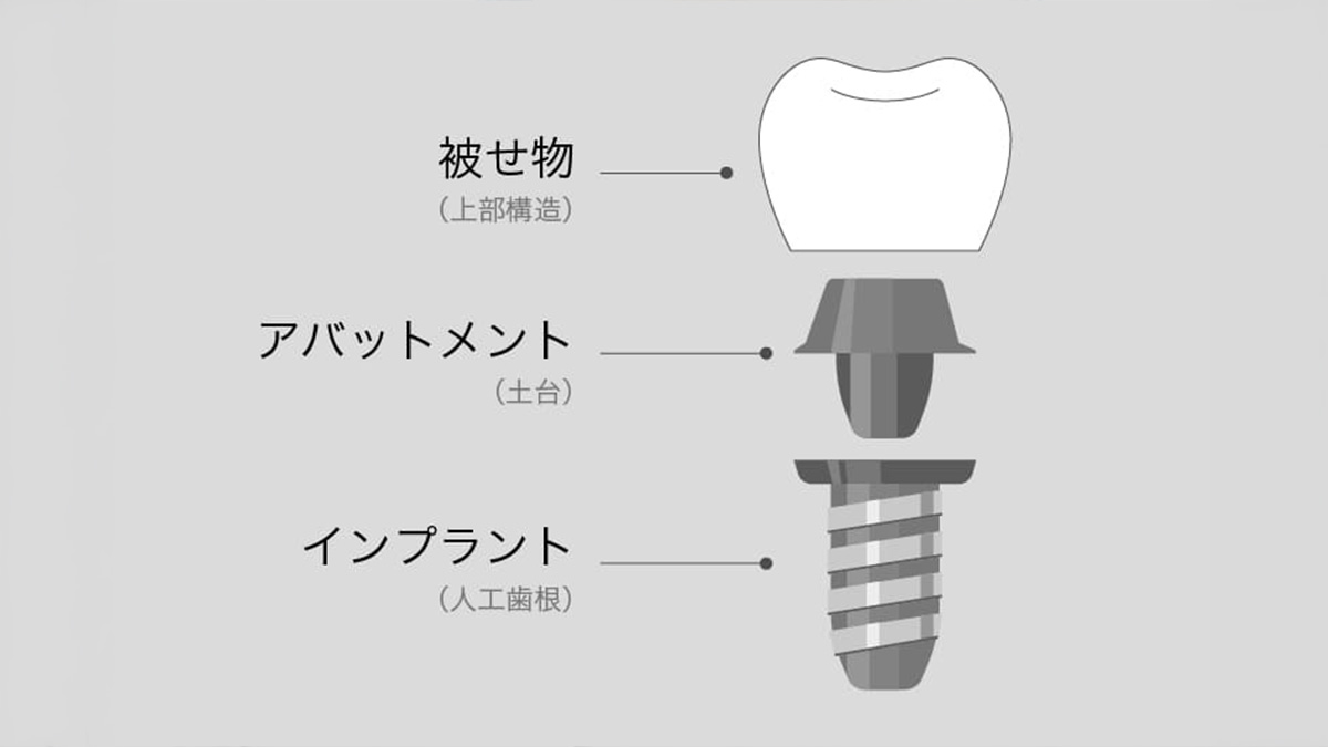 インプラント治療とは