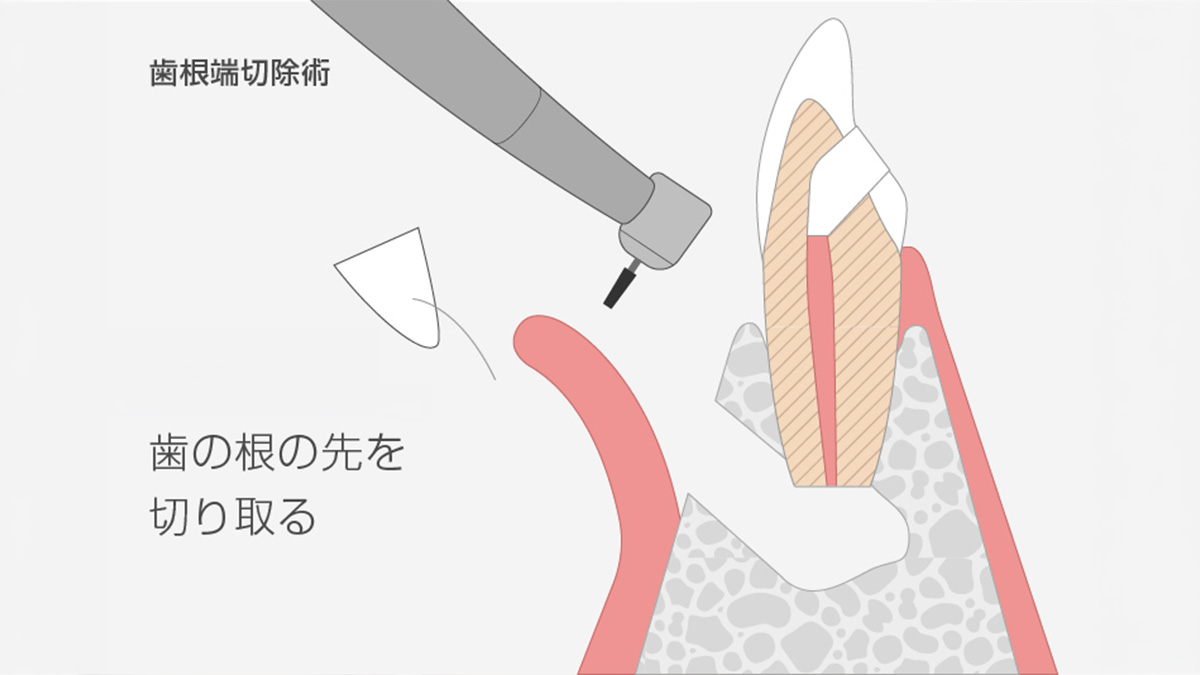 歯根端切除術