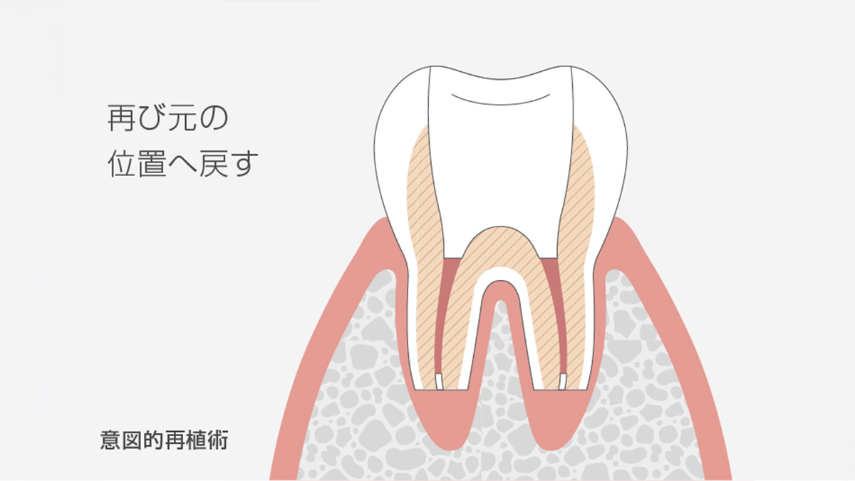 意図的再植術