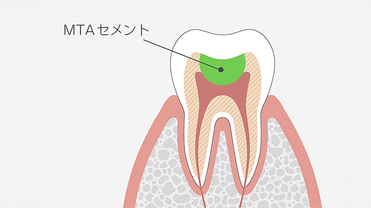 MTAセメント
