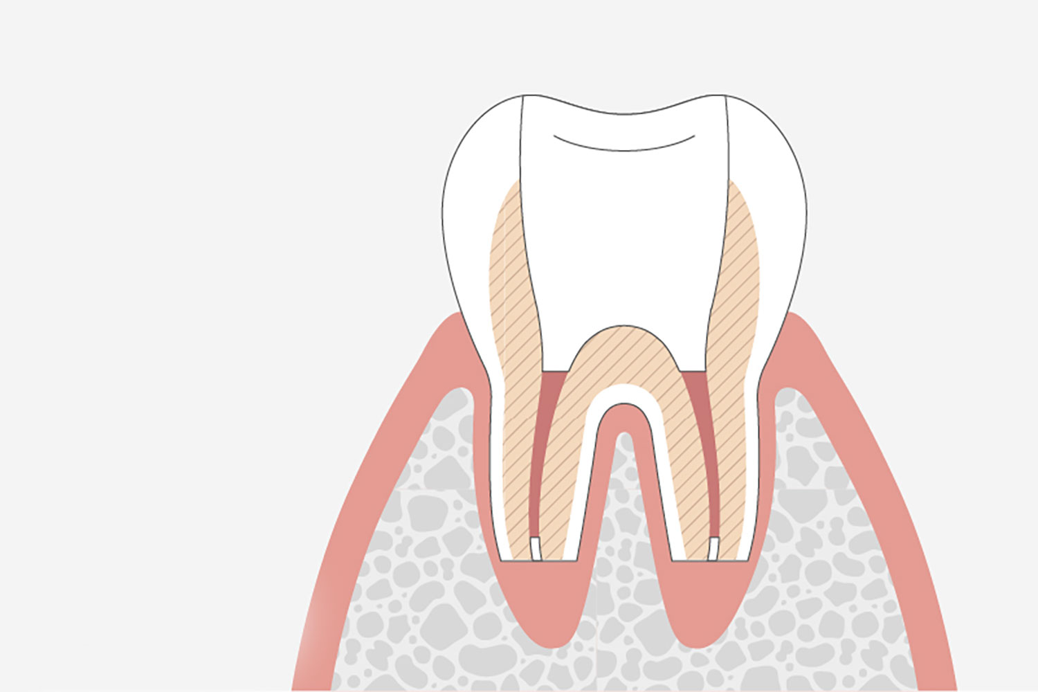 外科的歯内療法とは